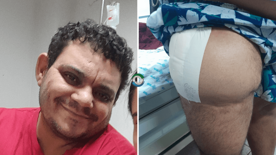 Após sofrer acidente de moto, vigilante de Sidrolândia cria vaquinha para custear gastos médicos