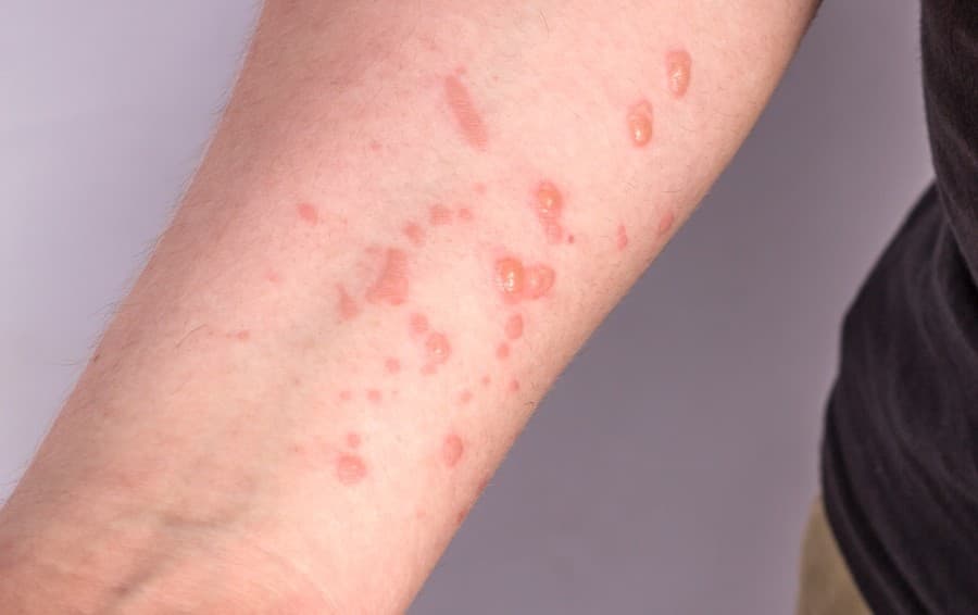 Jovem de 17 anos é diagnosticado com vírus Monkeypox em Sidrolândia