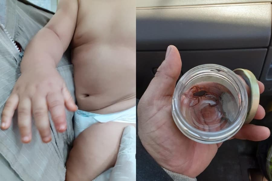 Bebê de 8 meses é picado na mão por escorpião amarelo enquanto brincava perto de árvore