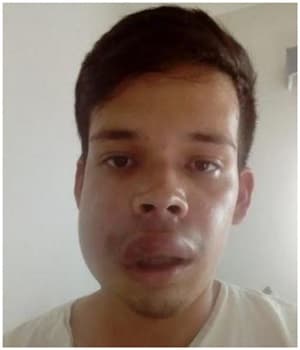 É grave estado de jovem argentino picado por aranha na área rural de Sidrolândia