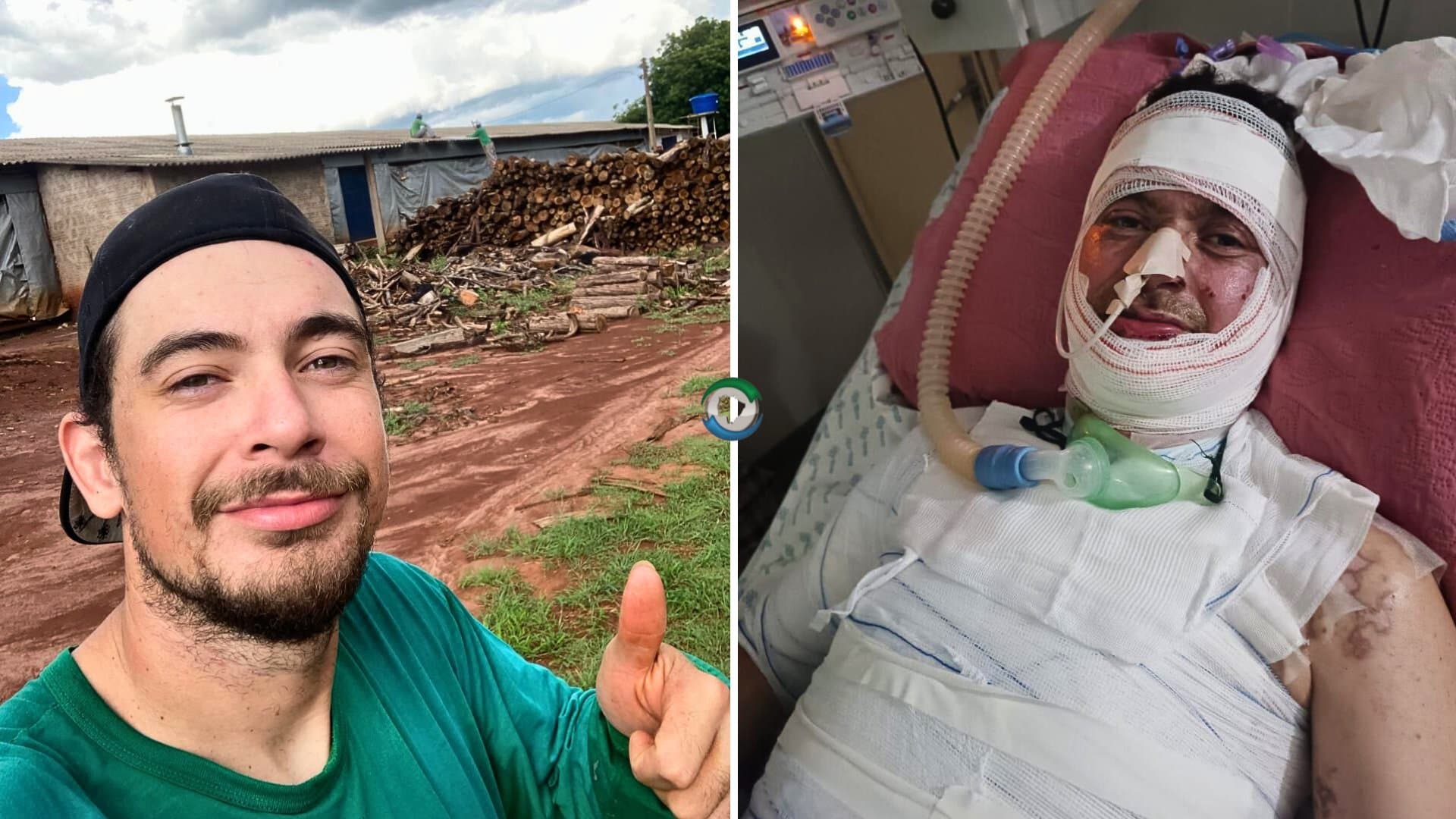 Sidrolandense de 26 anos sofre graves queimaduras e família cria rifa para viabilizar cirurgia urgente