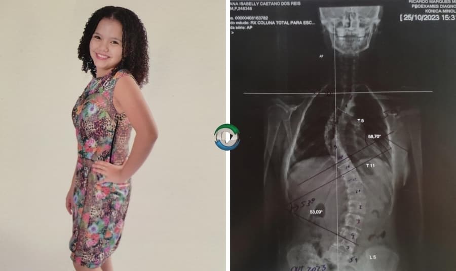Pai cria vaquinha online para custear cirurgia de reparação na coluna da filha
