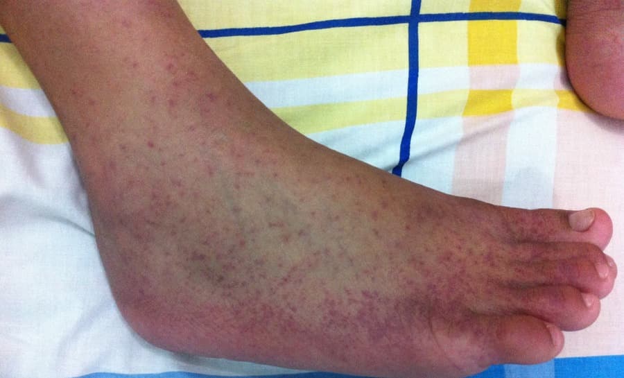 Secretaria Municipal de Saúde confirma primeiro caso de Chikungunya em Maracaju