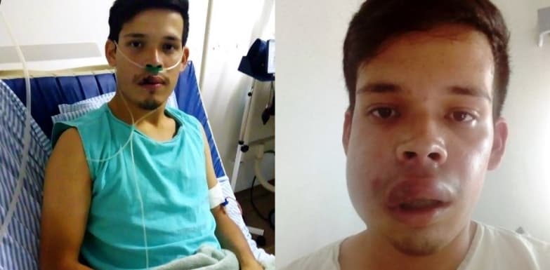 Ainda internado, jovem argentino picado por aranha em Sidrolândia já passou por duas cirurgias